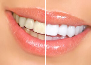 whitening compared after using best teeth whitening products