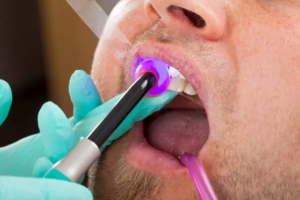 Composite Bonding
