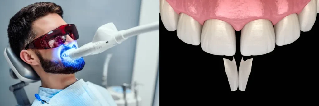 Composite Bonding