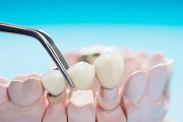 Dental Bridges