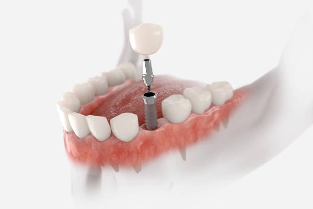Dental Transplants
