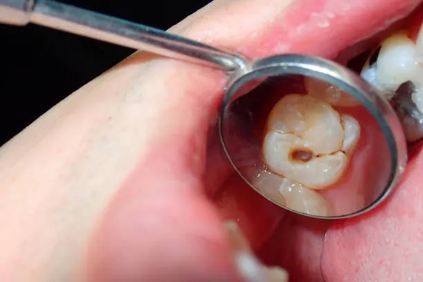 Fillings