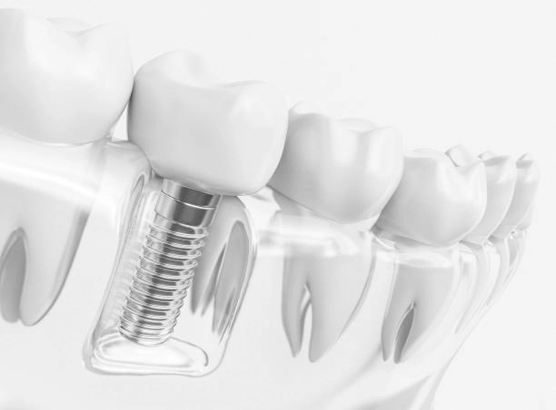 dental implants