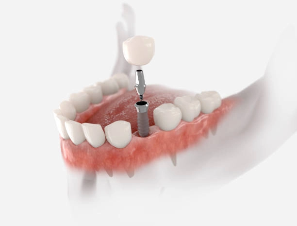 dental implants