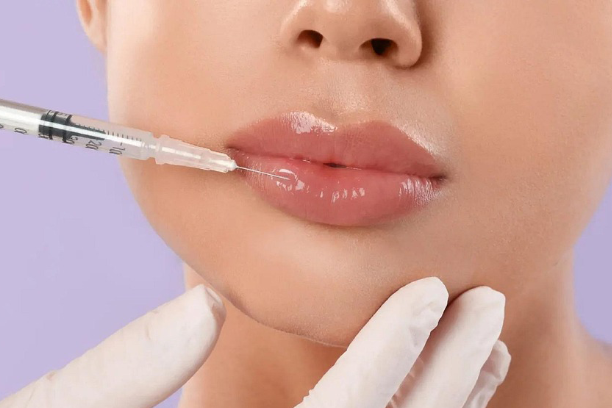 lip filler