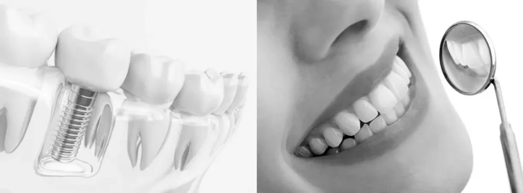seemless Dental Transplants