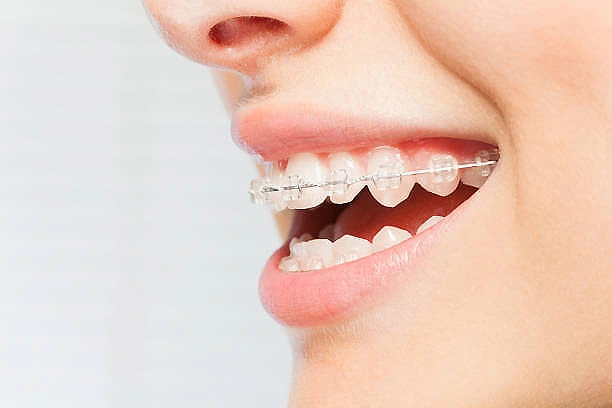 straighter smile with Orthodontist treatment