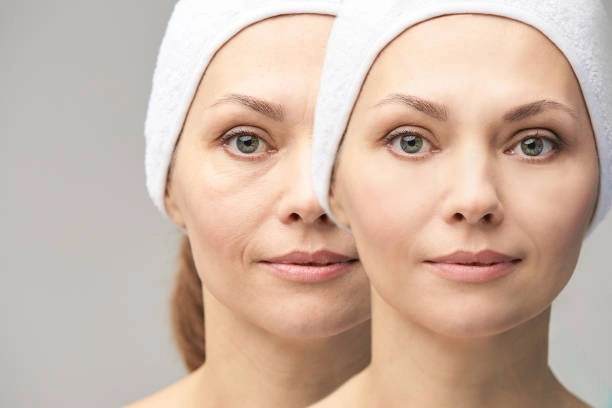 women after Tear Trough Filler treatment