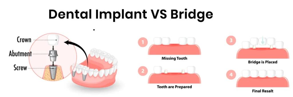 dental bridge vs implant placement and structural comparison