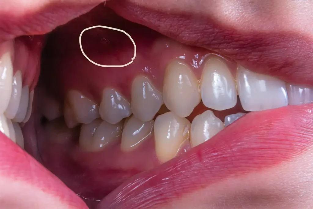 gum hole is visible in mouth 