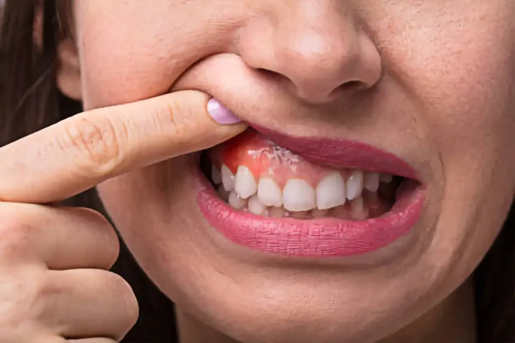 Women showing her infected gum