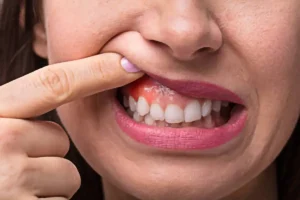 Women showing her infected gum