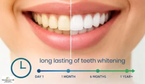 long lasting teeth whitening