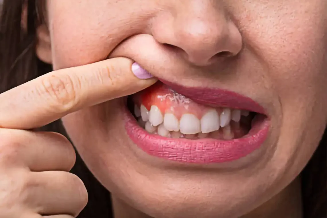 Women showing her infected gum